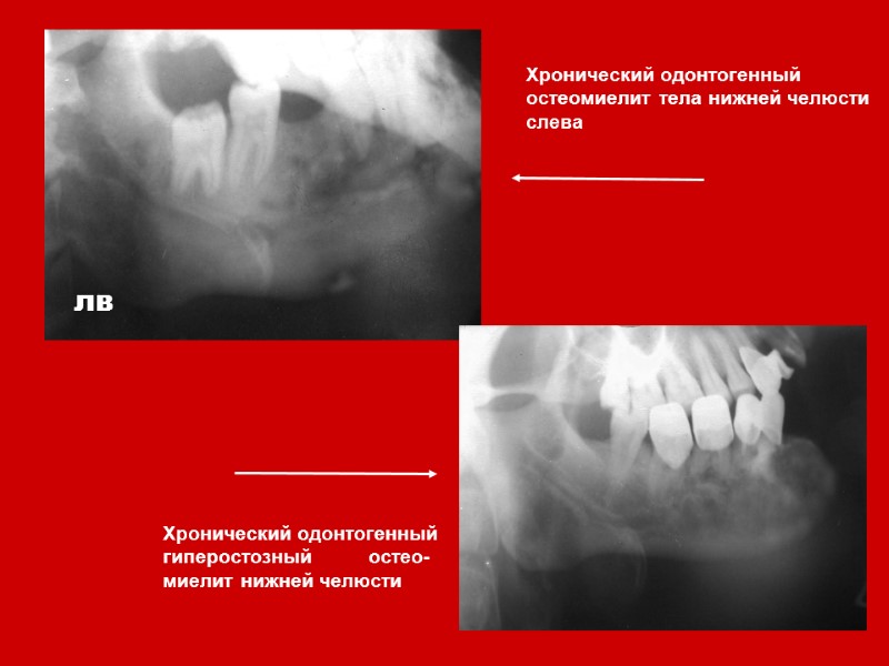 Хронический одонтогенный остеомиелит тела нижней челюсти слева лв Хронический одонтогенный гиперостозный   